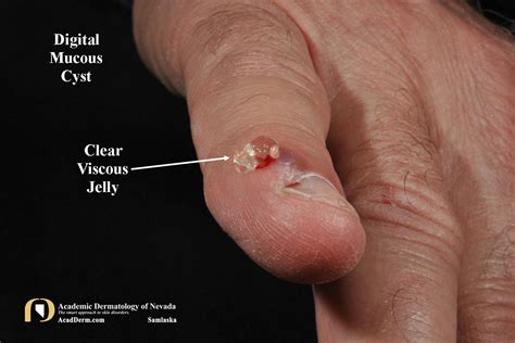 Digital Mucous Cyst (DMC): Myxoid Cyst... - Academic Dermatology of Nevada