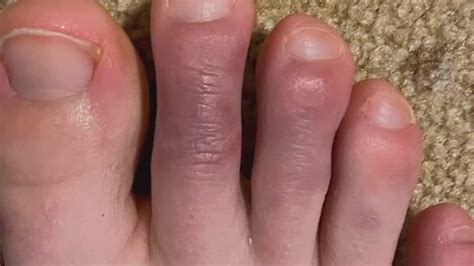 'COVID toes' are emblematic of how much is still unknown about the disease | FOX 5 New York