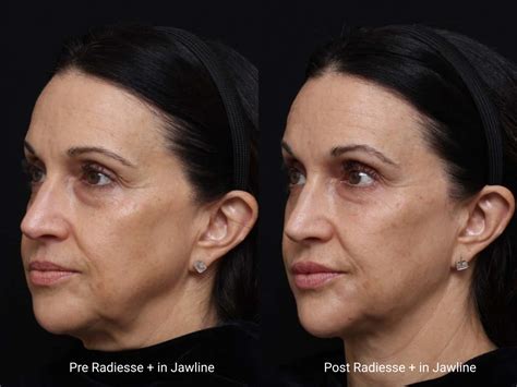 Jawline Contouring and Slimming: Jawline Filler or Jawline Botox ...