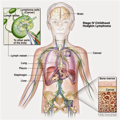 Lymphoma - Dream Health