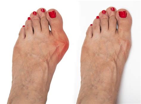 Bunion Be Gone: How Cutting-Edge, Minimally Invasive Surgery Can Transform Your Life and ...