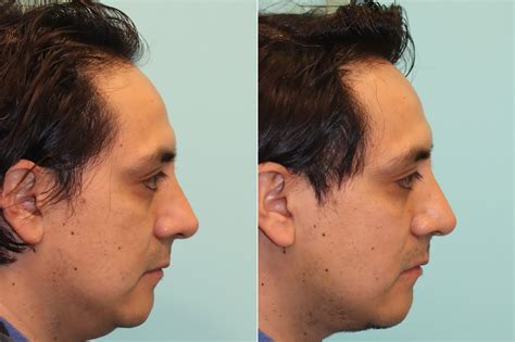 Submentoplasty photos | Chevy Chase, MD | Patient 24121