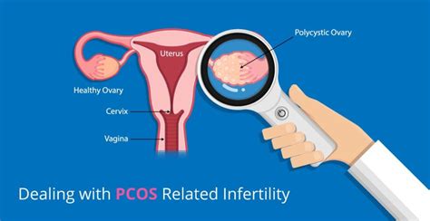 PCOS/PCOD - Dr Chanchal Sharma