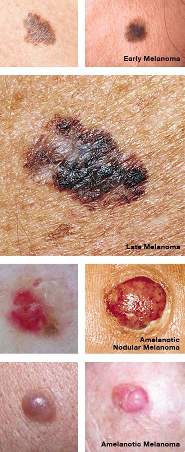 Melanoma is the most aggressive of the common skin cancers.