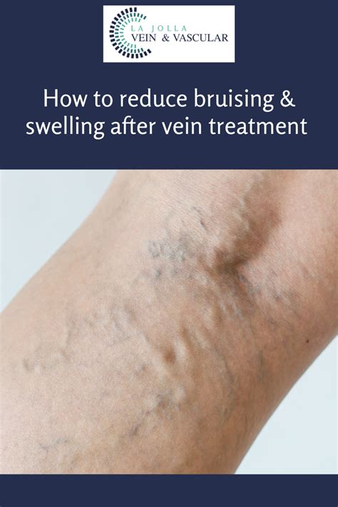 How to reduce bruising and swelling after vein treatment