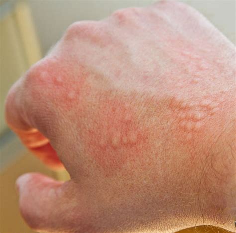 Allergic Reaction Skin Rash Itchy