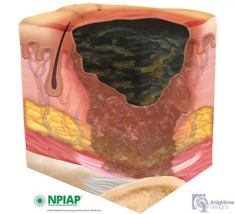 Pressure Ulcers Stage 1