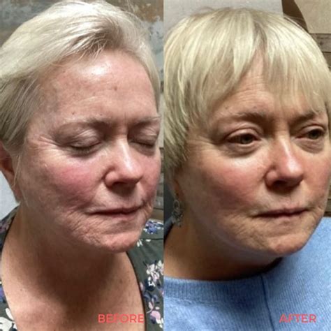 Radiofrequency Microneedling Before & After