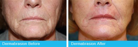 Dermabrasion – Holley Surgical Arts