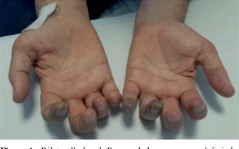 Figure 1 from Cryoglobulinemic vasculitis as a rare complication of rheumatoid arthritis : a ...