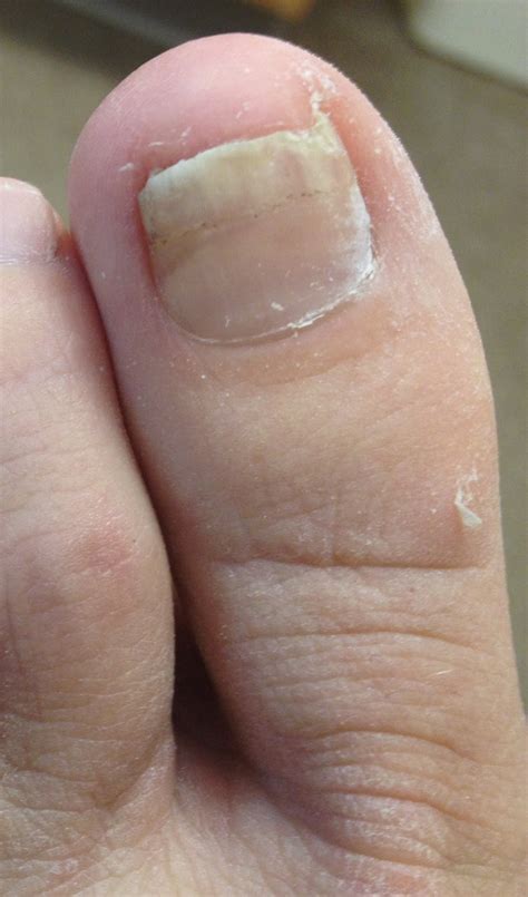 Hammer Toe Causes Pain | dawncorvera