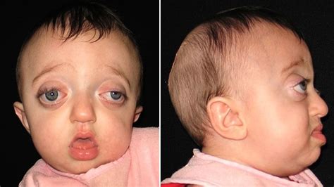 Pfeiffer Syndrome: Symptoms, Causes, Treatments | Its Psychology