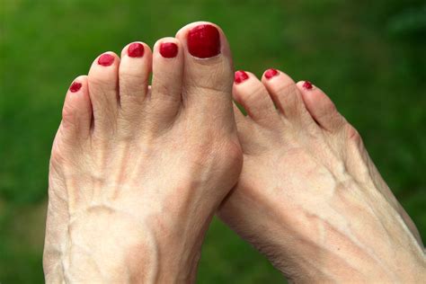 What Is a Bunion? - Celebration Foot & Ankle Institute