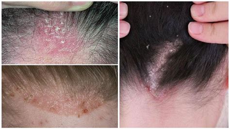 Hair mite in people's heads - symptoms and treatment