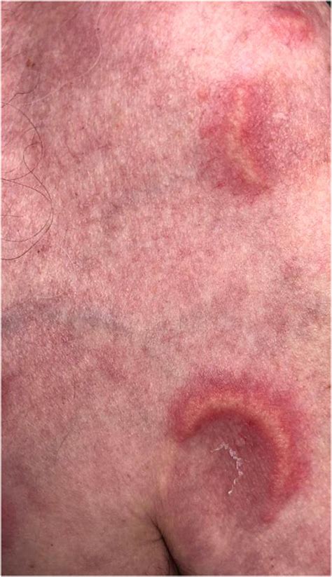 Clinical and pathological features of cutaneous manifestations in VEXAS syndrome: A multicenter ...