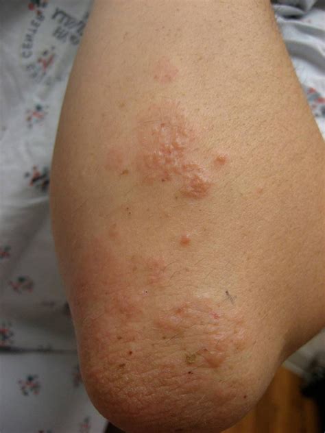Dermatitis Herpetiformis