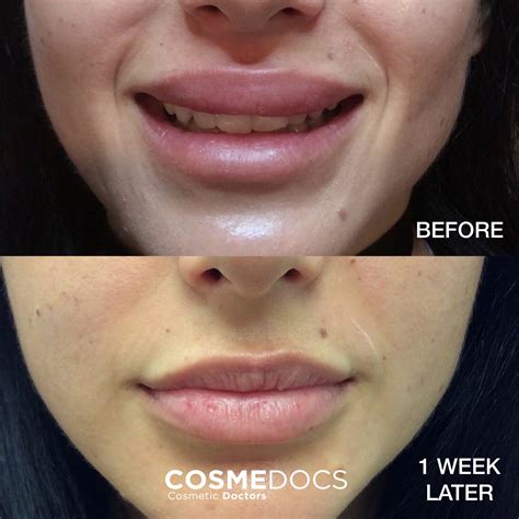 Bad Lip Injections Before And After