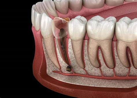 Endodonzia, trattamenti della polpa dentale e devitalizzazione a Fano