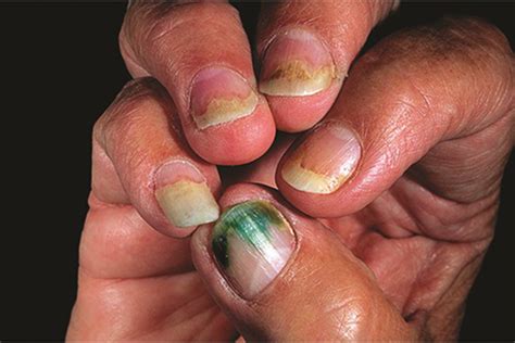 Pseudomonas Aeruginosa Nail Infection - Nail Ftempo