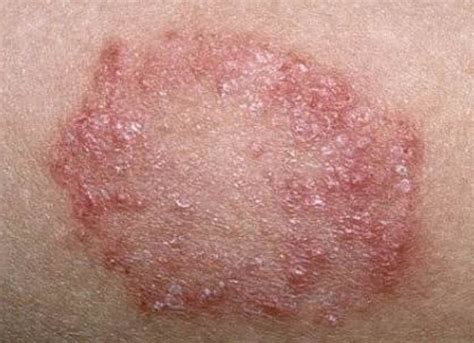 Rash 36 Common Skin Rashes Pictures Causes Treatment - vrogue.co