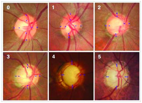 Photographs of the optic disc showing a normal disc (0) and optics with... | Download Scientific ...