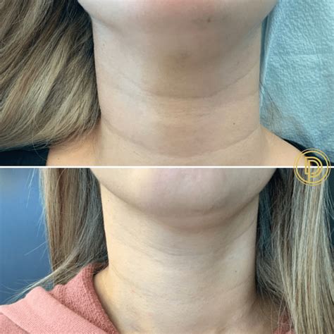 Neck Rejuvenation Dallas | Dallas Dermatology Partners