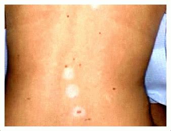 What is skin cancer?: What are Halo Nevi