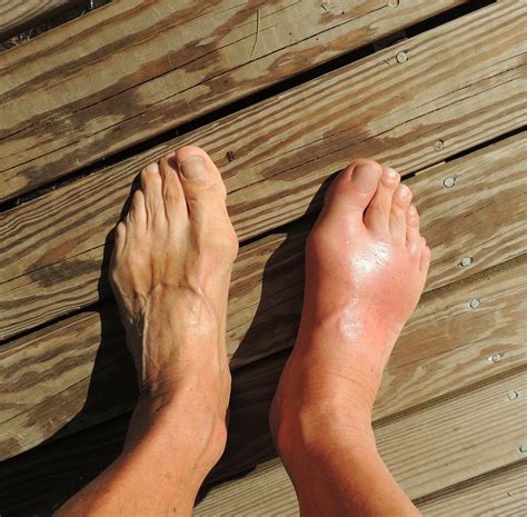Gout Treatment | Gout Symptoms | Worthington Foot & Ankle