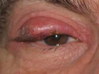 Eye Diseases: Symptoms, Causes, Treatment, and Eye Diseases List