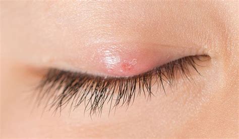 Eyelid bumps are red, pimple-like lumps that are usually harmless and go away on their own. The ...