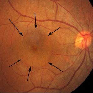 What is central serous retinopathy? - Jaheed Khan | London Cataract Surgeon