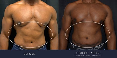 Does CoolSculpting® Work For Men? Everything You Need To Know: