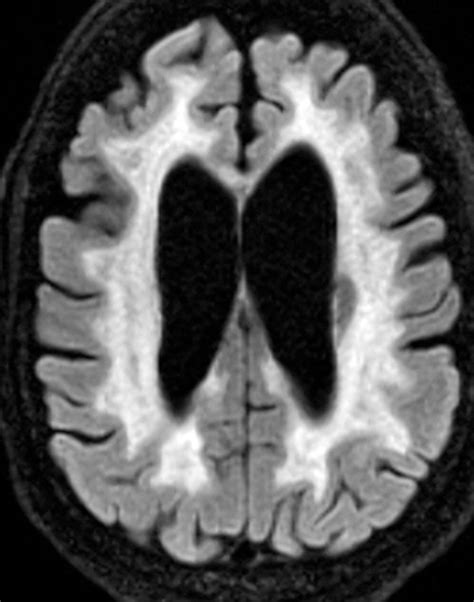 Adult Leukodystrophies: A Step-by-Step Diagnostic Approach | RadioGraphics