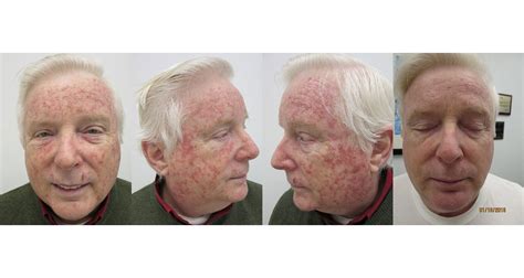 Before & After | DermAssociates Rockville | U.S. Dermatology Partners