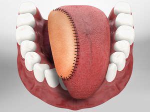 Glossectomy - Willis-Knighton Health System