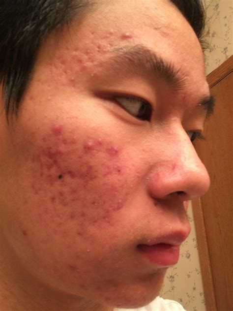 [Acne] Help fading post acne marks! : r/SkincareAddiction