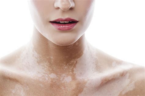 Vitiligo Treatment | Brisbane Skin Dermatologists