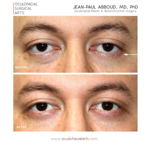 Almond Eye Procedure and Lower Eyelid Lift (Lateral Canthoplasty and Lower Retraction Repair)