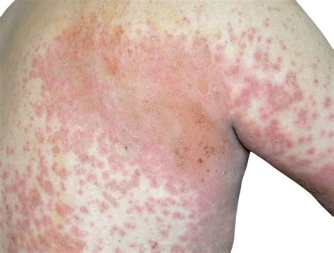 Skin Pathology Commonly Associated With HIV Infection - Infectious ...