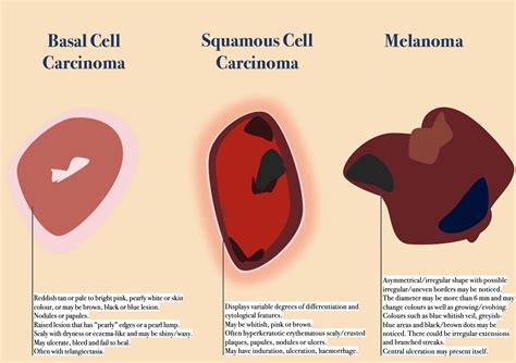 Main Type of Skin Cancer — Their Differences, Histology and Prevention. — Andréas Astier