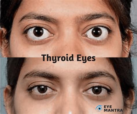 thyroid eye disease photos Thyroid eye disease - Diseases Club Center 2