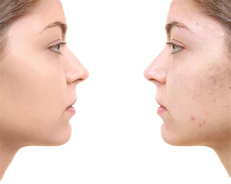 Acne & Blemishes — Midwest Laser Centre