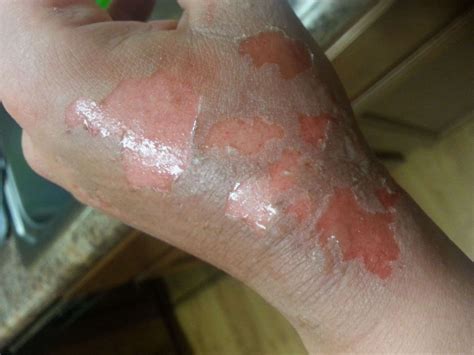 2nd Degree Burn Healed