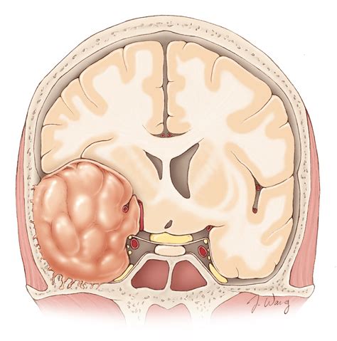 General Information for Meningiomas | Patient Resource Center | The Neurosurgical Atlas, by ...