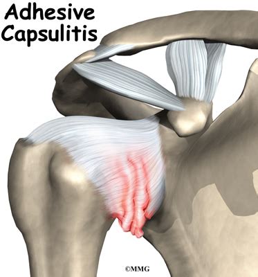 Adhesive Capsulitis | Houston Methodist