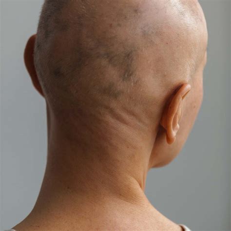 Alopecia Treatment - EDCC