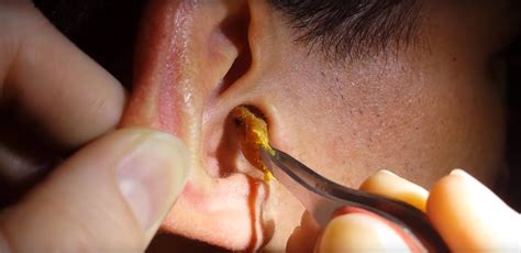TOP GIANT EAR WAX REMOVAL! 2016 | Ear wax removal, Clogged ears, Ear wax