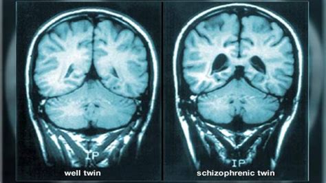 Schizophrenia: Facts, Symptoms and Causes - Education Today News