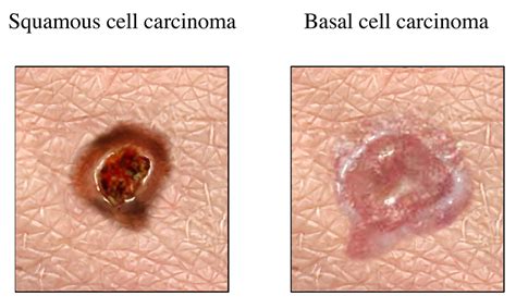 Basal Cell Carcinoma Facts | City of Hope