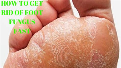 Feet Fungus